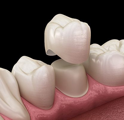 Model of an all-ceramic dental crown.