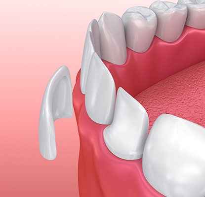 Animation of porcelain veneer placement