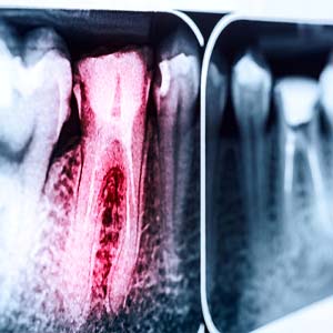 X-ray of a tooth that needs root canal therapy and affects the cost of a root canal