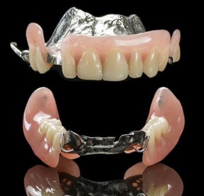 partial denture metal clasp