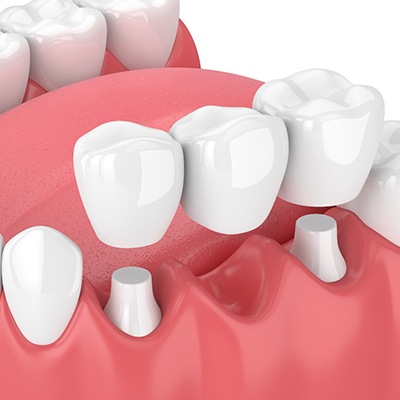 dental bridge and crowns