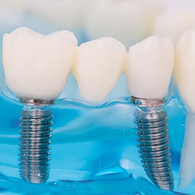 implant-supported bridge