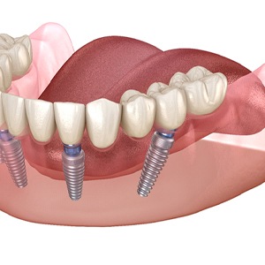 Graphic of implant dentures in East York