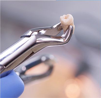 Metal clasp holding extracted tooth