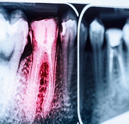 X-ray of tooth highlighted red