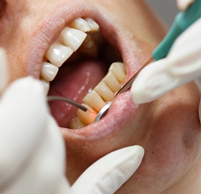 patient getting their gums recontoured