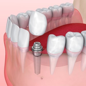 Digital illustration of a dental implant placed in a jaw