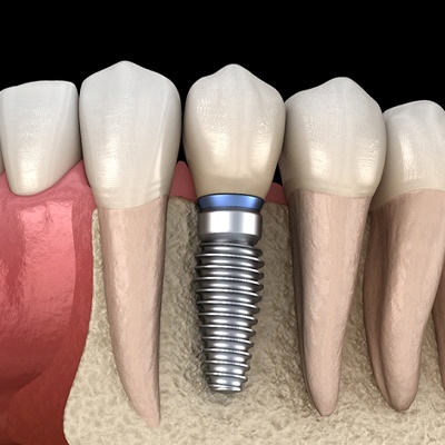 dental implant set in jawbone