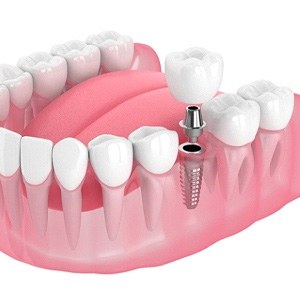 a model of dental implants