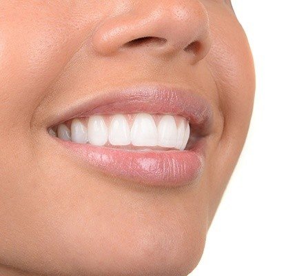 : a closeup of a patient’s complete smile