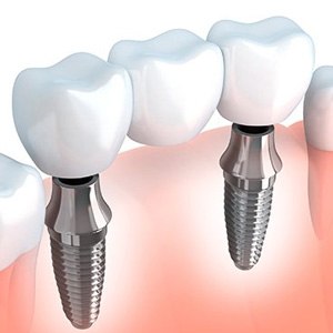 : a model of dental implants