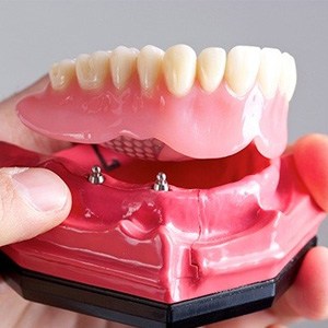 a closeup of implant-retained dentures