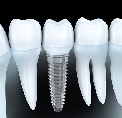 Animation of implant supported dental crown