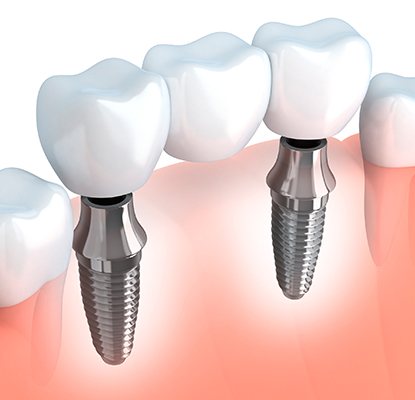 Animation of implant supported fixed bridge
