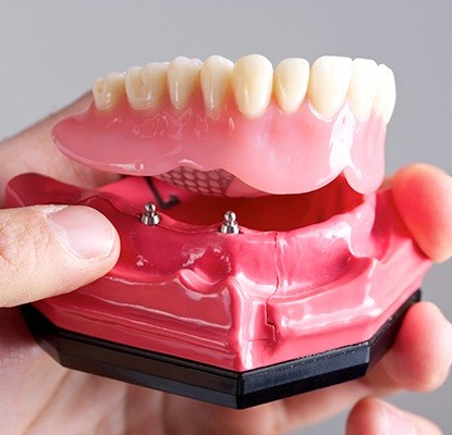 Model of implant supported denture