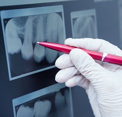 Pen pointing to damaged tooth on x-ray