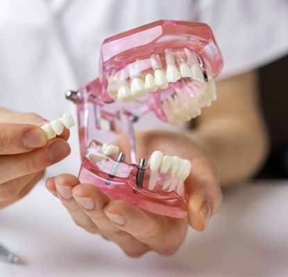a dentist holding onto a model of dental implants