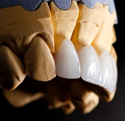 veneers being placed over model teeth