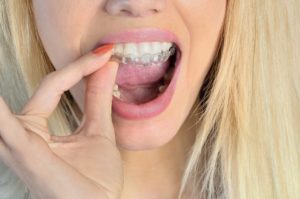 blond woman putting in Invisalign clear aligners