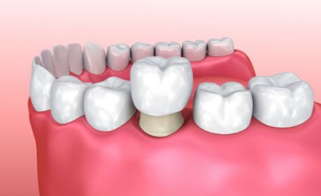 Image of a same-day dental crown on a lower tooth