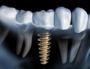 Image used for dental implant terms you should know