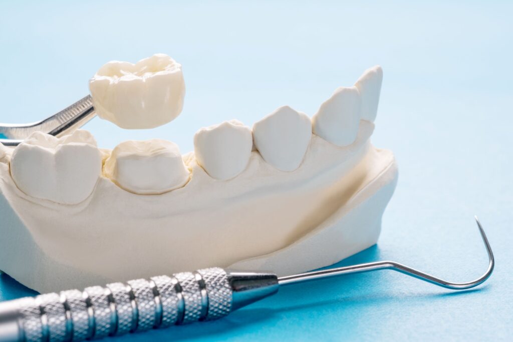 Dental crown held by forceps above model jaw